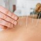 Top Physical Therapy Dry Needling Clinics Near You | Physical Health & Fitness – Boost Your Body, Energy, and Wellbeing