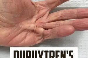 Effective Dupuytren's Contracture Physical Therapy & Exercises Physical Health & Fitness – Boost Your Body, Energy, and Wellbeing Effective Dupuytren's Contracture Physical Therapy & Exercises | Physical Health & Fitness – Boost Your Body, Energy, and Wellbeing
