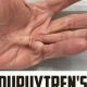 Effective Dupuytren's Contracture Physical Therapy & Exercises | Physical Health & Fitness – Boost Your Body, Energy, and Wellbeing