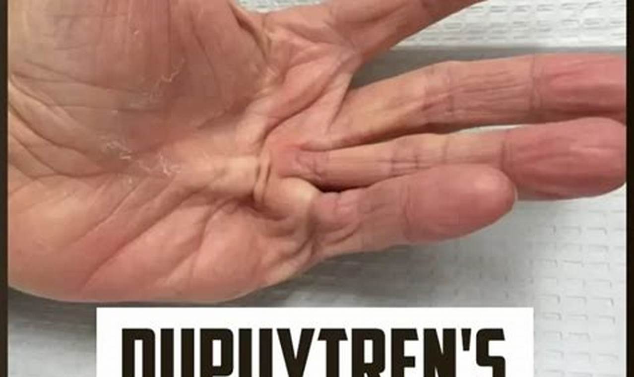 Effective Dupuytren's Contracture Physical Therapy & Exercises